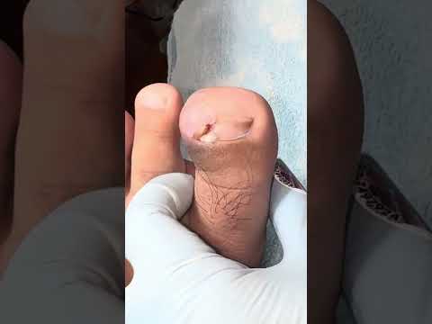 Ep_7836 Big ingrown toenail removal 👣 ซุปเปอร์บิ๊ก 😄 (clip from Thailand)