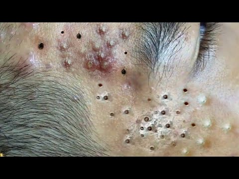 Big Cystic Acne Blackheads Extraction Blackheads & Milia, Whiteheads Removal Pimple Popping # 3917