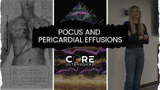 Ultrasound Diagnosis of Pericardial Effusion and Tamponade in the ED