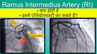 100% blocked Ramus Artery एंजियोप्लास्टी l #angioplasty #drnagendrathalor
