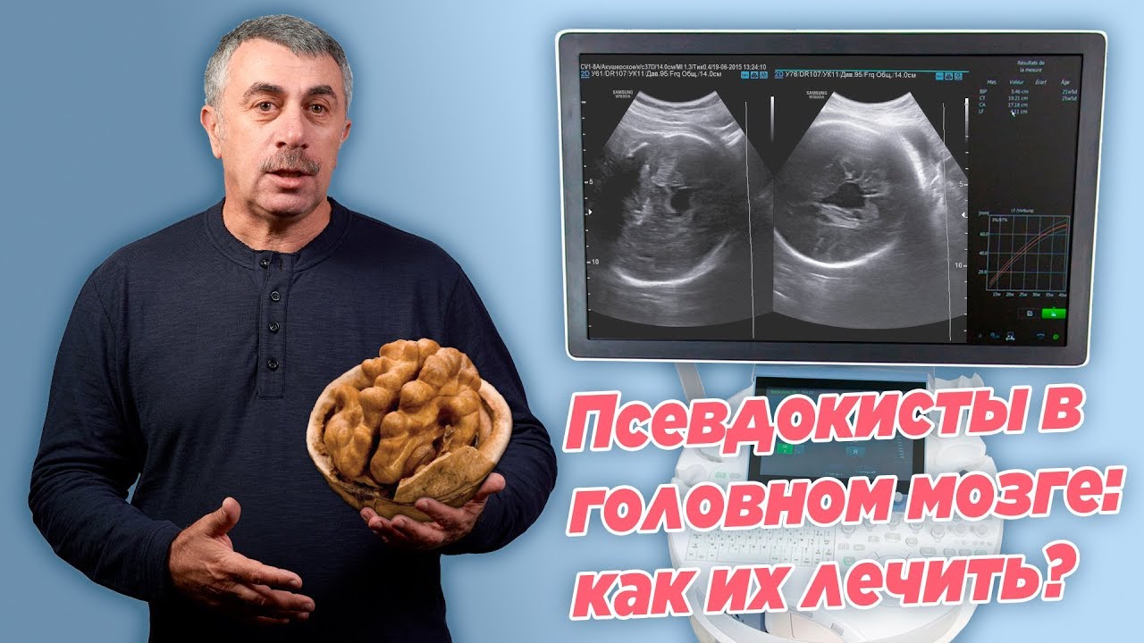 Псевдокисты в головном мозге: как их лечить?