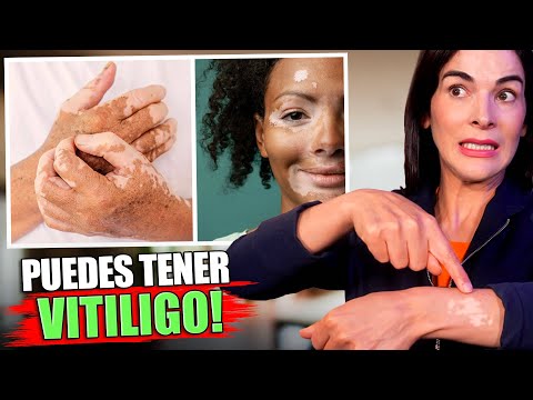 ¿CÓMO DESHACERSE DEL VITÍLIGO? Puedes desencadenar estas manchas en tu cuerpo si no lo evitas