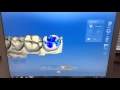 SARE Crown Procedure Overview