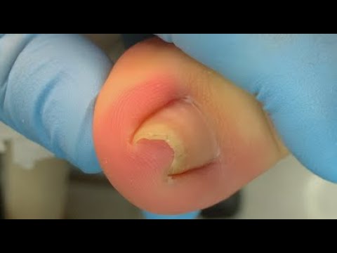 How to repair nails