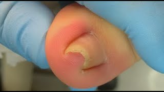 How to repair nails