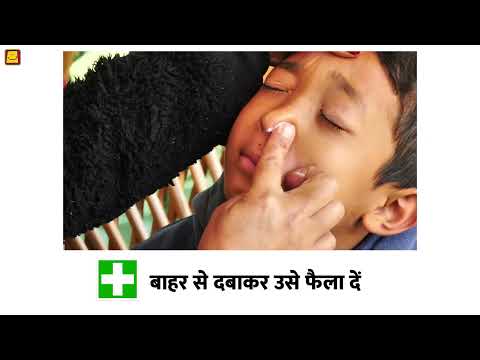 First aid for Foreign body in Nose (Hindi) | नाक में कुछ फँस जाने पर प्राथमिक उपचार