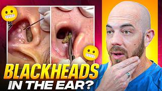 Dermatologist Reacts to INSANE Pimple Pops & Skincare NIGHTMARES