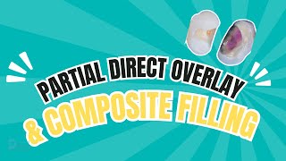 Partial direct overlay & composite filling