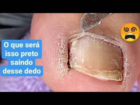 Olha Isso Preto que Tirei Embaixo Desse Dedo.O que Será???