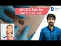 ABCDE Guideline for Skin Lesions