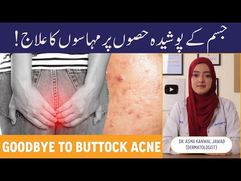 How To Treat Buttock Acne - Kulho Par Dano Ka Ilaj - Kali Baghlon Ki Wajah - Hips Par Pimple Ka Ilaj