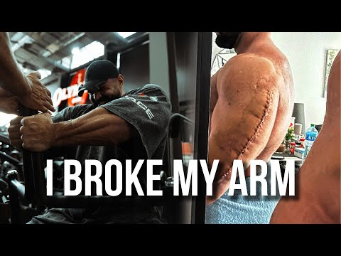 BROKEN ARM | SURGERY | PREP 2024 | FULL CHEST WORKOUT