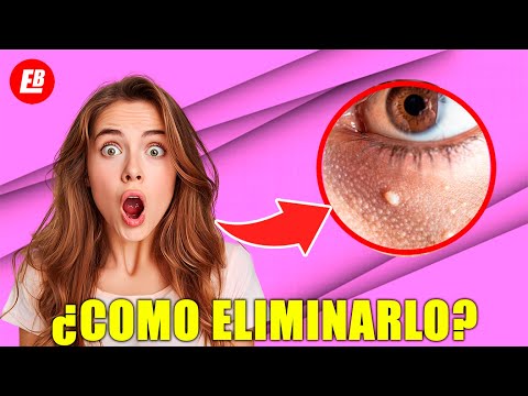 ¿Cómo eliminar los QUISTES DE MILLIUM o MILIA? Tratamiento Dermatologico