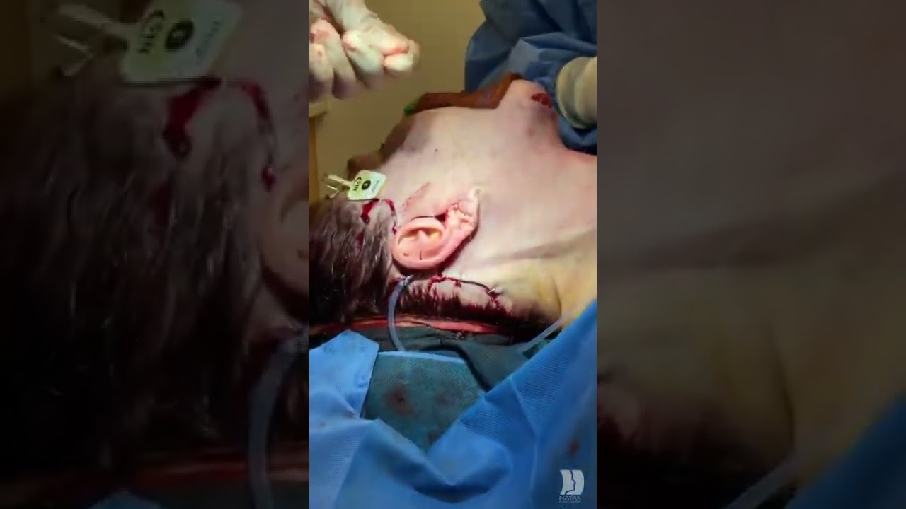 Surgical procedure on a patient's head.