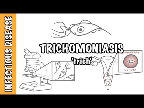 Trichomoniasis | Causes, Symptoms, Diagnosis & Treatment | STI Explained by Doctor