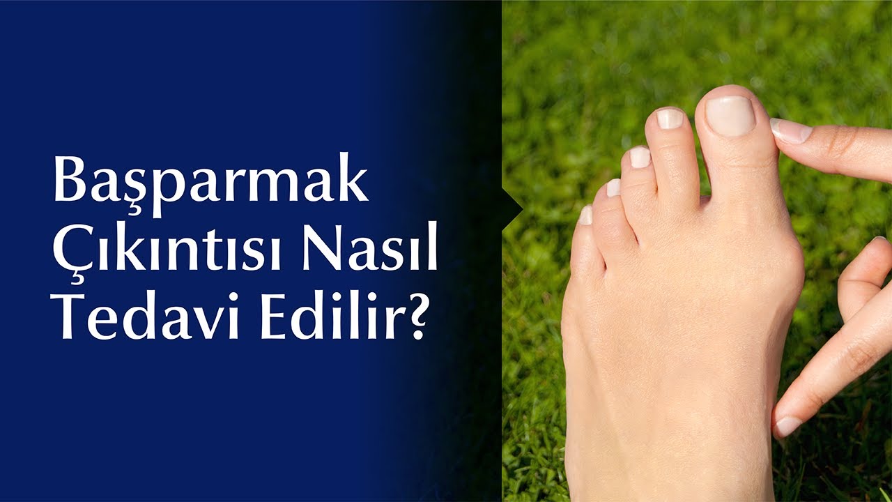 Halluks Valgusun (Ayak Başparmak Çıkıntısı) Belirtileri ve Tedavi Yöntemleri Nelerdir?