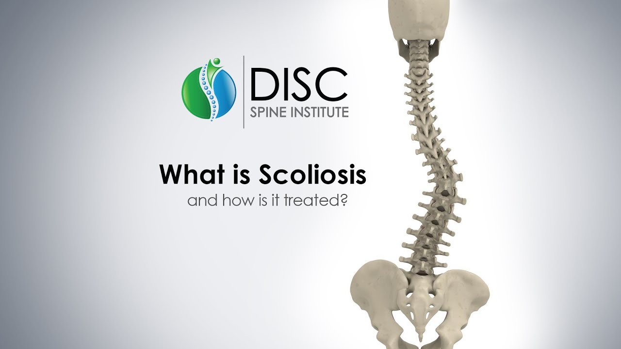 A Brief Overview of Scoliosis
