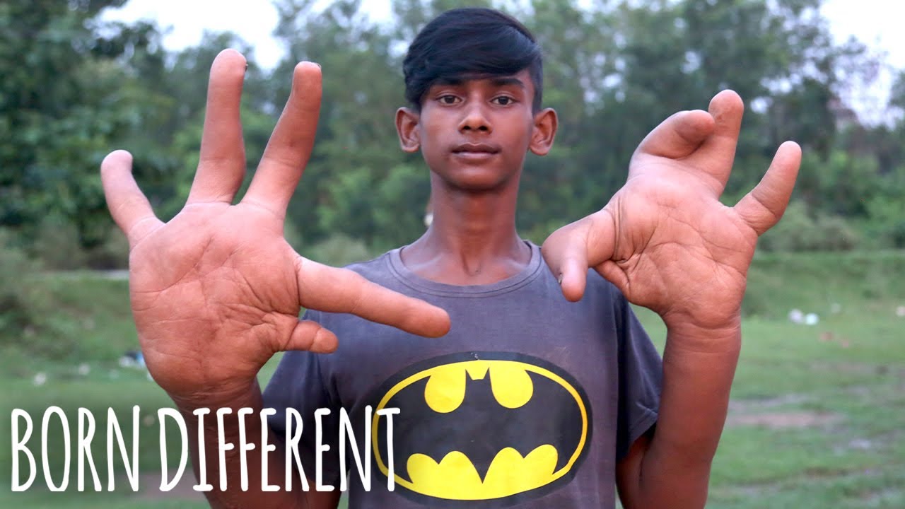 The teen with the giant hands - born different
