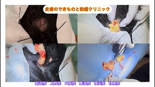 頭部の粉瘤　上野院　横浜院　札幌院も出来ました　ブログでも粉瘤について詳しく解説してます。東京皮膚のデキモノと粉瘤クリニック　ふるばやし形成外科　東京新宿院大阪難波院　大阪梅田形成外科クリニック