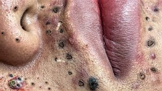 Blackhead Removal With Sac Dep Spa @100074685