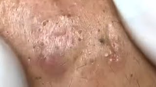 Blackheads & Whiteheads Satisfying Removal Acne and Pimple @0792