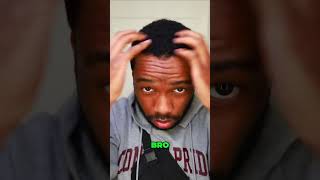 Quick Hair Transplant update 👨🏾‍🦲‼️ #skincare