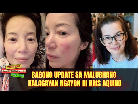 Bagong update sa malubhang kalagayan ngayon ni Kris Aquino