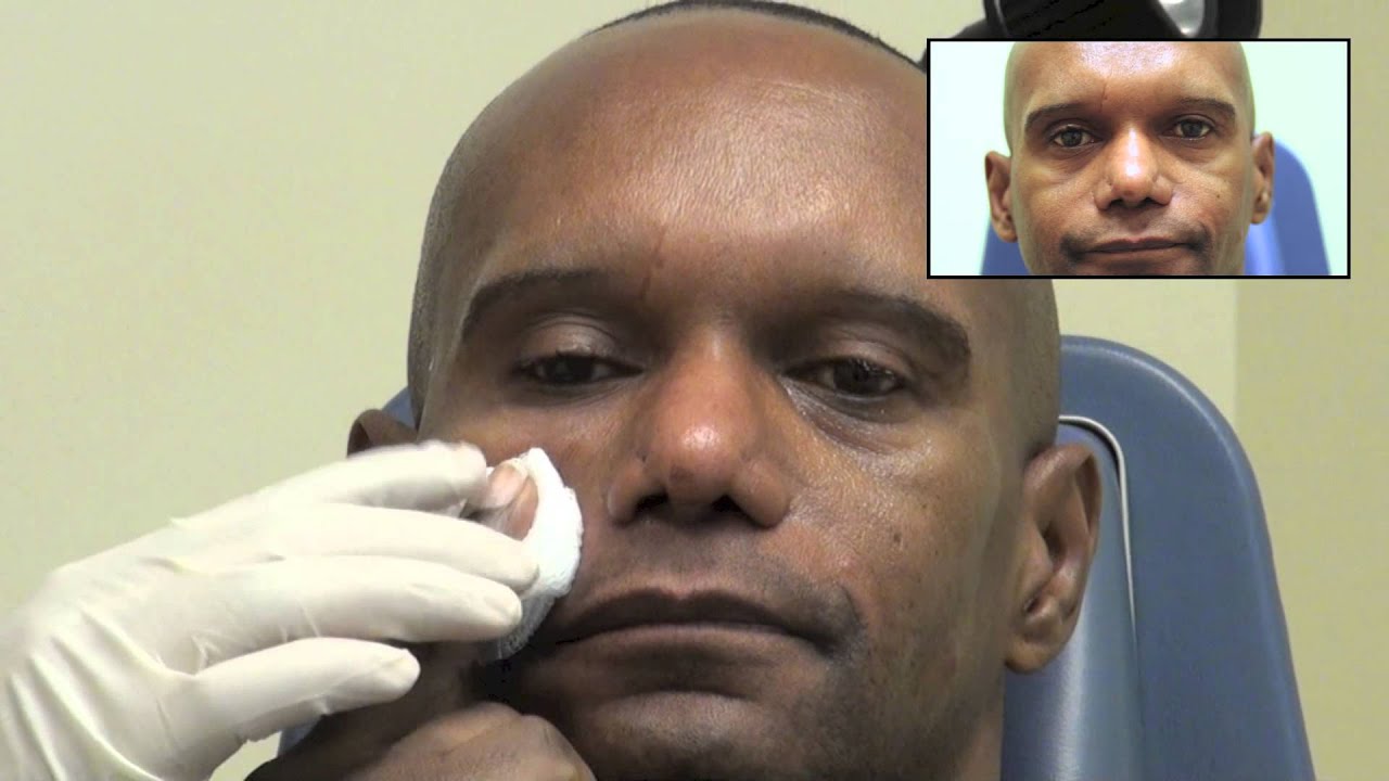 Patient receiving skincare treatment on his face.