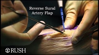 Reverse Sural Artery Flap