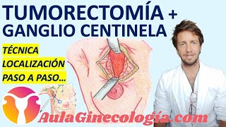 TUMORECTOMÍA GUIADA POR ARPÓN + BIOPSIA SELECTIVA DEL GANGLIO CENTINELA EN EL CÁNCER DE MAMA 🦀