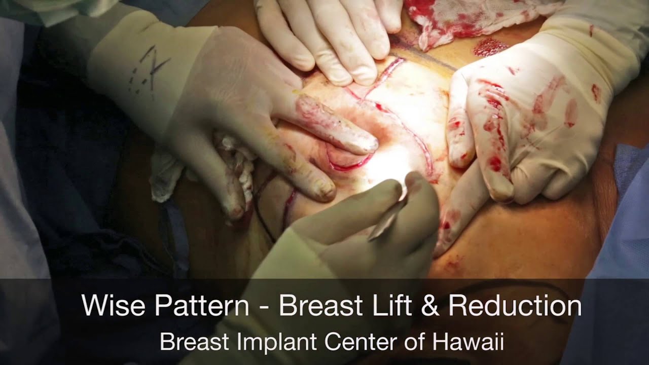 Breast Lift and Reduction with Breast Implants - Graphic Surgery - Breast Implant Center of Hawaii