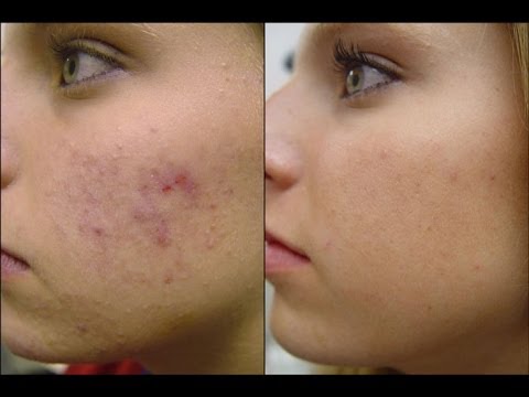 Mascarilla para el Acne y Anti Edad Natural para Todo Tipo de Piel