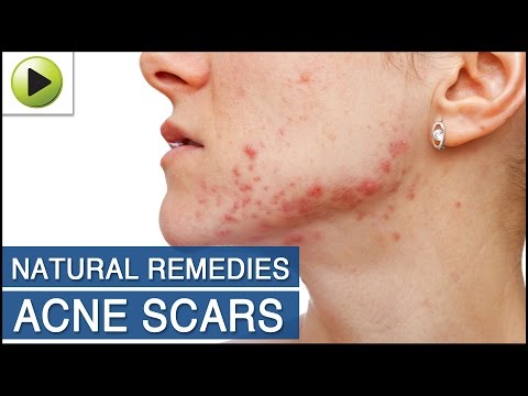 Skin Care : Acne Scars - Natural Ayurvedic Home Remedies