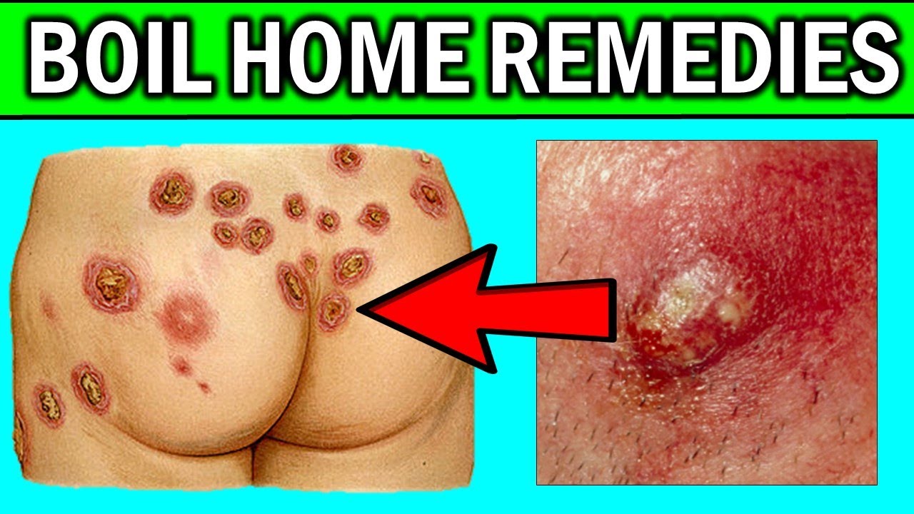 How to Treat and Remove Boils From the Body and Private Parts Using Natural Remedies