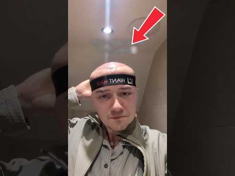 Funniest hair transplant ๐ #shortsfeed #short