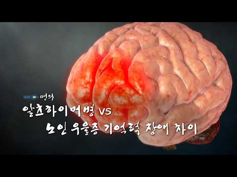[명의 의학백과📖] 알츠하이머병 vs 노인 우울증 기억력 장애 차이