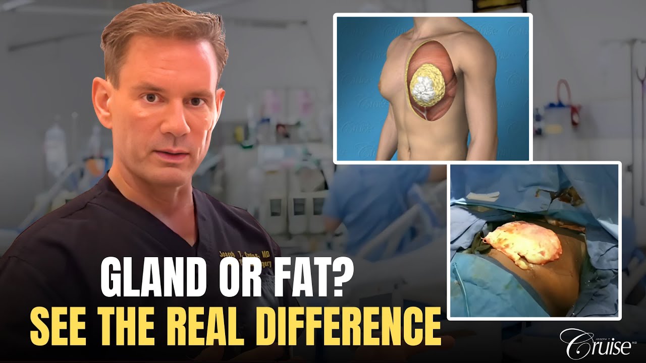 Comparison of gland versus fat in surgery.