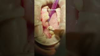 Limpieza dental con láser #shorts