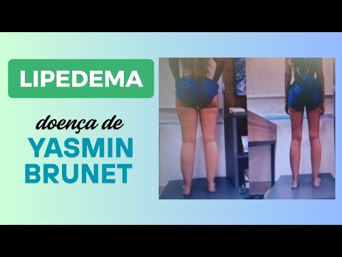 Doença Vascular Crônica Yasmim Brunet - LIPEDEMA