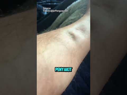 Fakta dari Kulit Tidak Kembali Semula Atau Piting Edema! #shorts