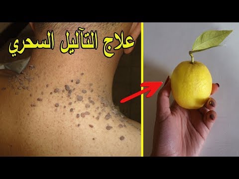 بليمونة واحدة فقط تخلصي من الثآليل ستتختفي وتموت للأبد /علاج الزوائد الجلدية نهائيا