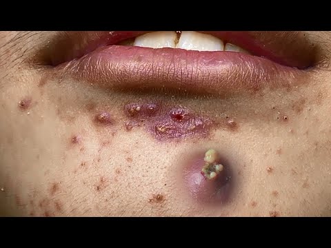 Big Cystic Acne Blackheads Extraction Blackheads & Milia, Whiteheads Removal Pimple Popping # 8404