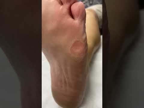 Aussie Podiatrist's Corn Removal Magic Unveiled #FootCare #PodiatryMagic