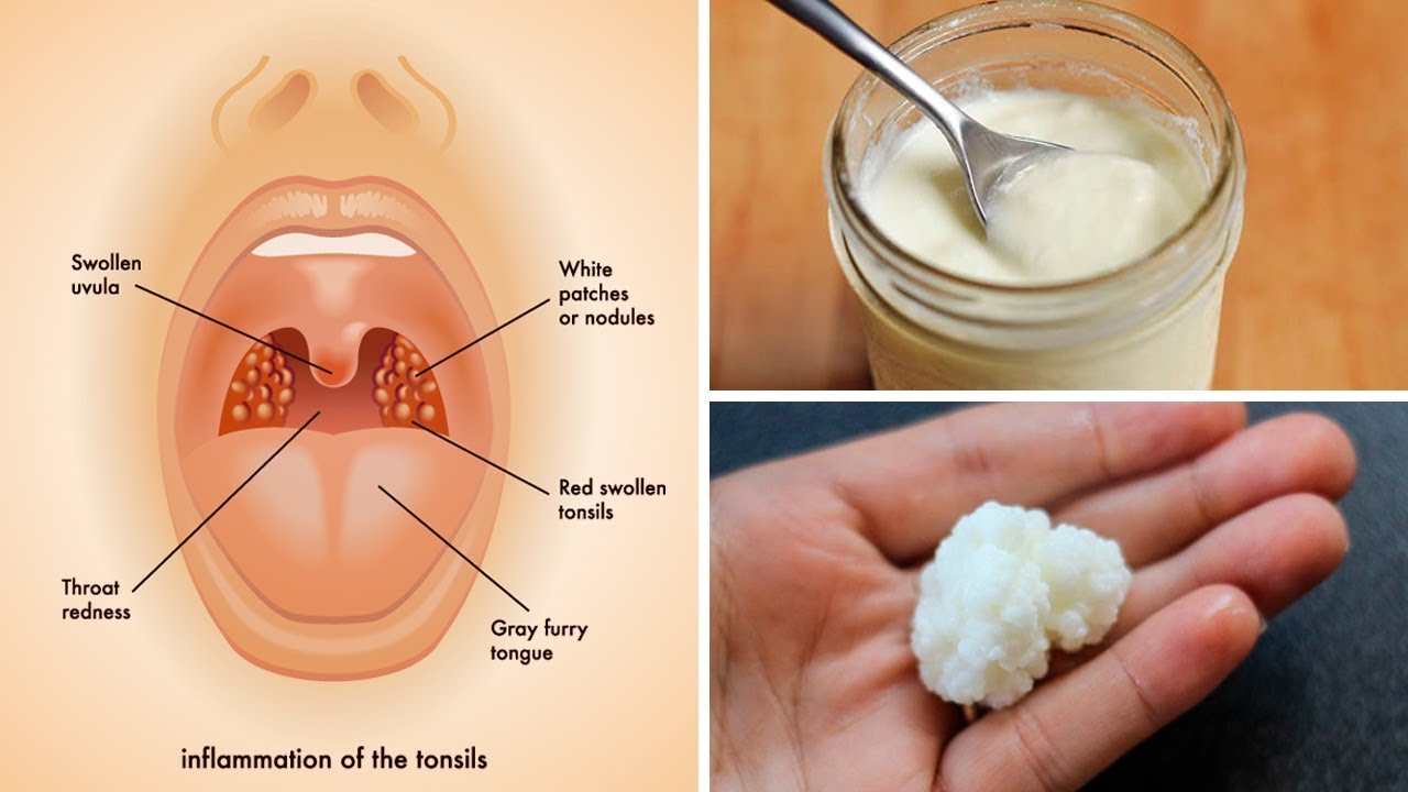 3 Powerful Home Remedies for Tonsillitis that Work Fast!