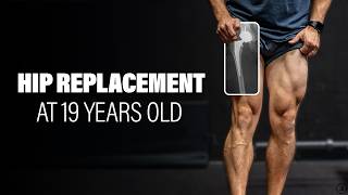Total Hip Replacement at 19 Years Old (16 Years Later)