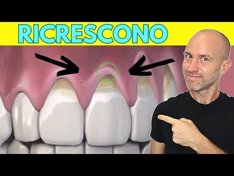 Come far ricrescere le gengive ritirate risolvere la retrazione gengivale a casa
