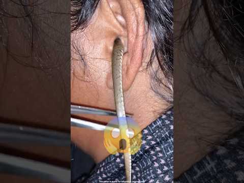 लड़की के कान में घुसा सांप | #shorts