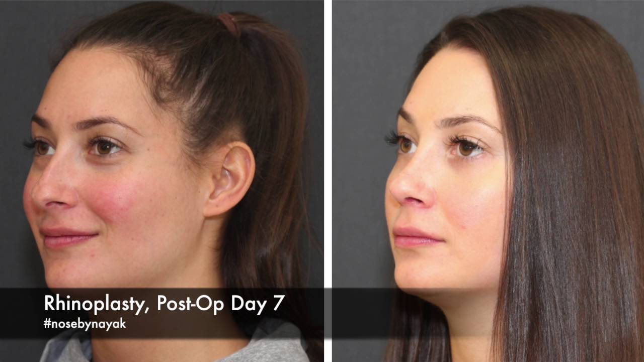 Rhinoplasty results, post-operative day seven comparison.