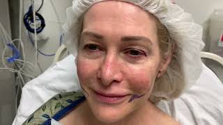 Lower Facelift and Upper Blepharoplasty- Before and 3 Weeks Postop! #facelift