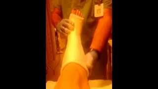 Broken Ankle: Getting my Cast! | Kimberly Ann
